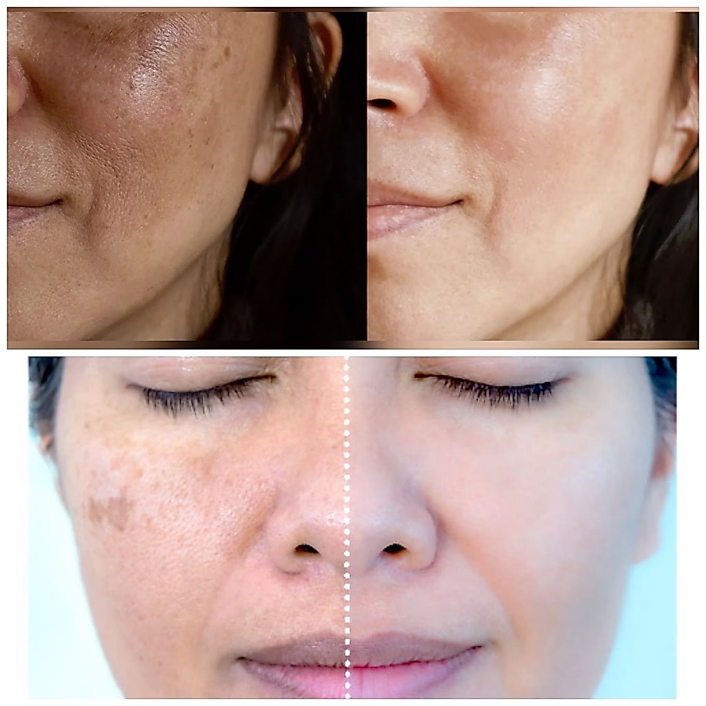 Antes e depois: manchas escuras e melasma clareados