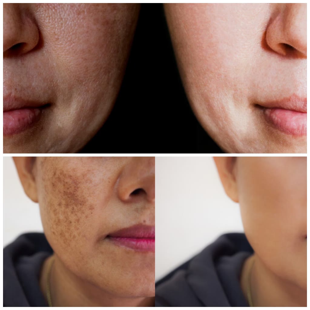 Antes e depois: manchas da pele uniformizadas