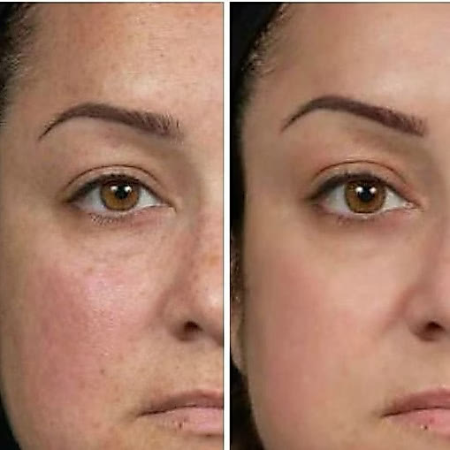 Antes e depois: rugas ao redor dos olhos suavizadas