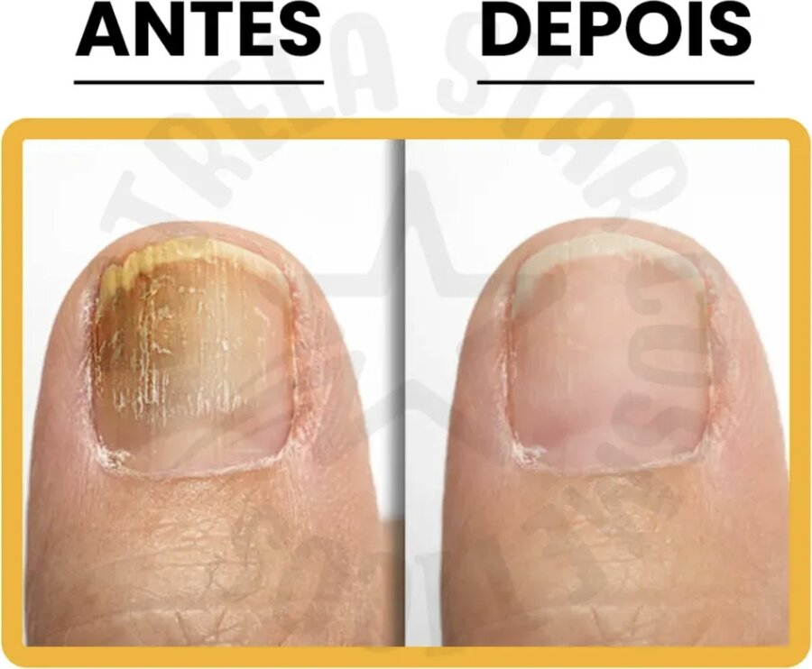 Pomada Micosan: antes e depois